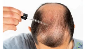 ماینوکسیدیل برای درمان ریزش مو 